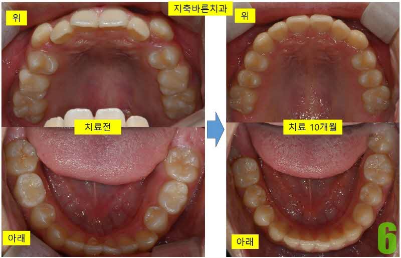 6. 치료 10개월 상하악_s.jpg