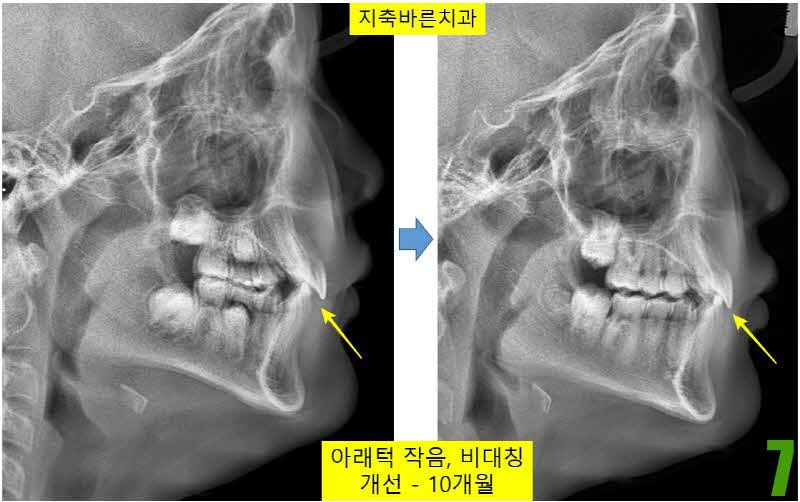 7. 치료 10개월_s.jpg