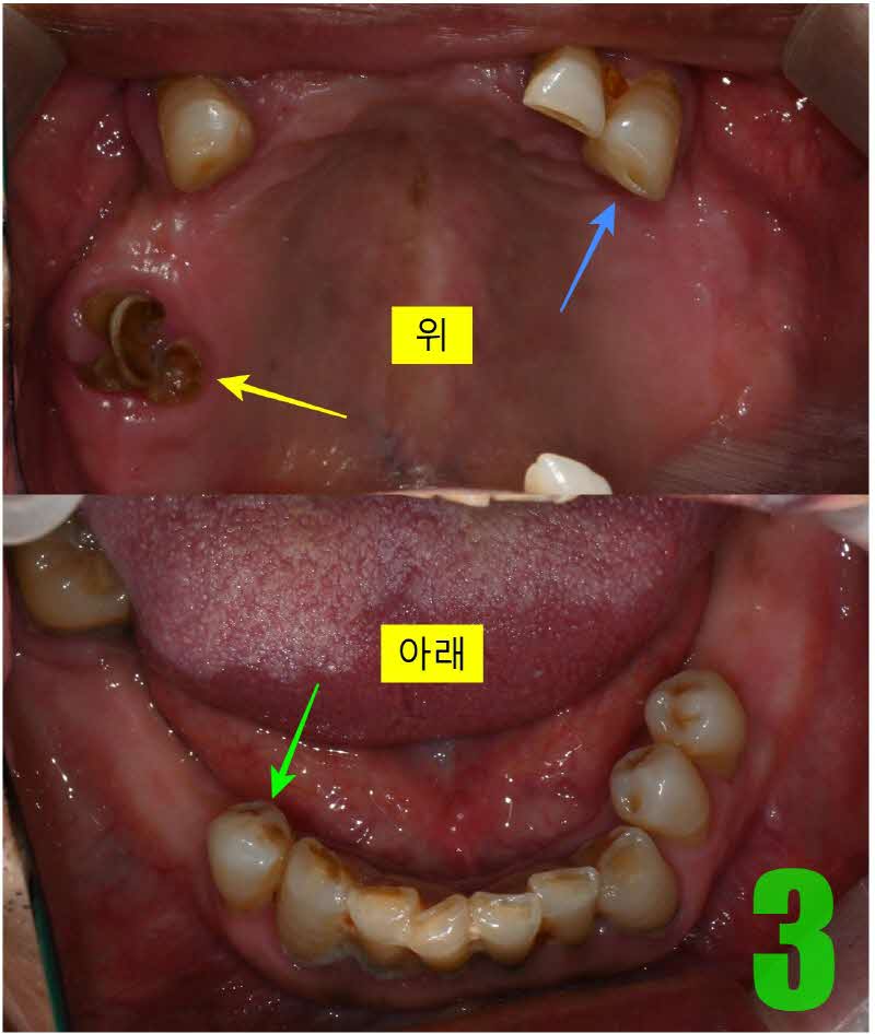 3. 상하악 교합면_s.jpg