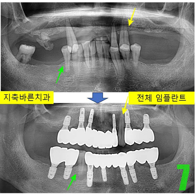 7. 최종보철_s.jpg