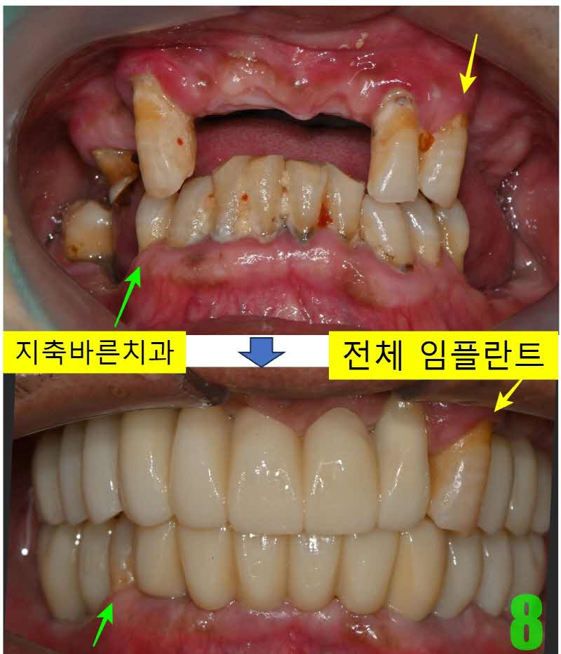 8. 치료전후 정면_s.jpg