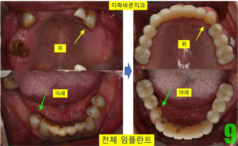 9. 치료전후 교합면_s.jpg