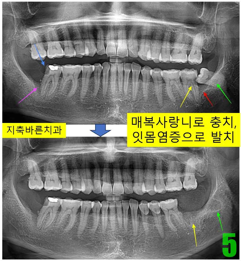 5. 사랑니 발치_s.jpg