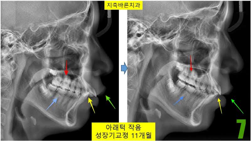 7. 11개월 셉_s.jpg