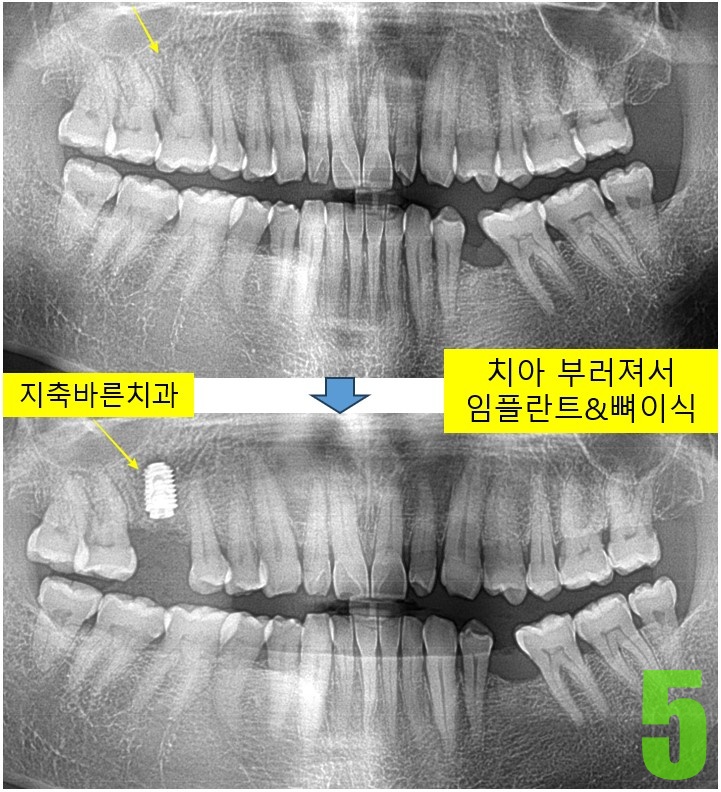 5. #16 임플 식립.jpg