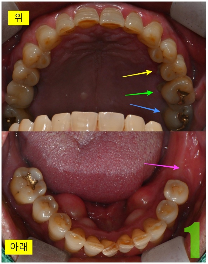 1. 초진 교합면.jpg