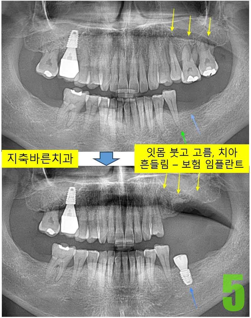 5. #36 임플 식립_s.jpg