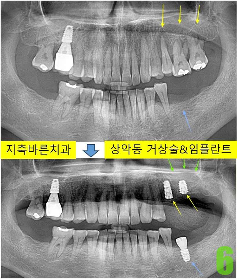 6. #25,26 임플 식립_s.jpg