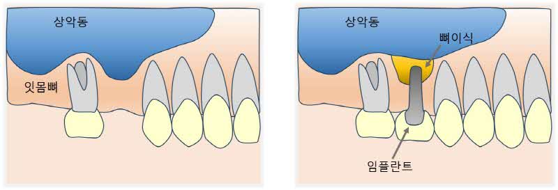 상악동 거상술_s.jpg