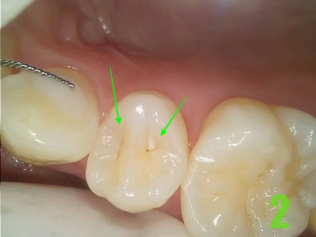 2. #14 충치.jpg