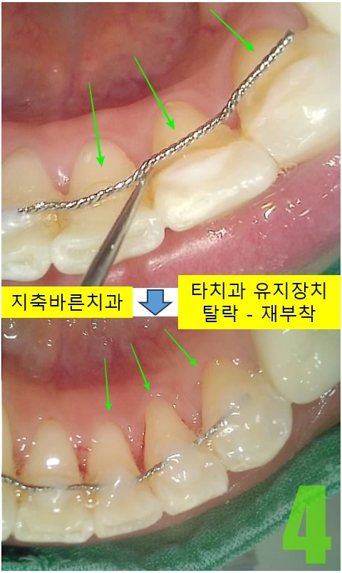 4. 타치과 유지장치 탈락.jpg