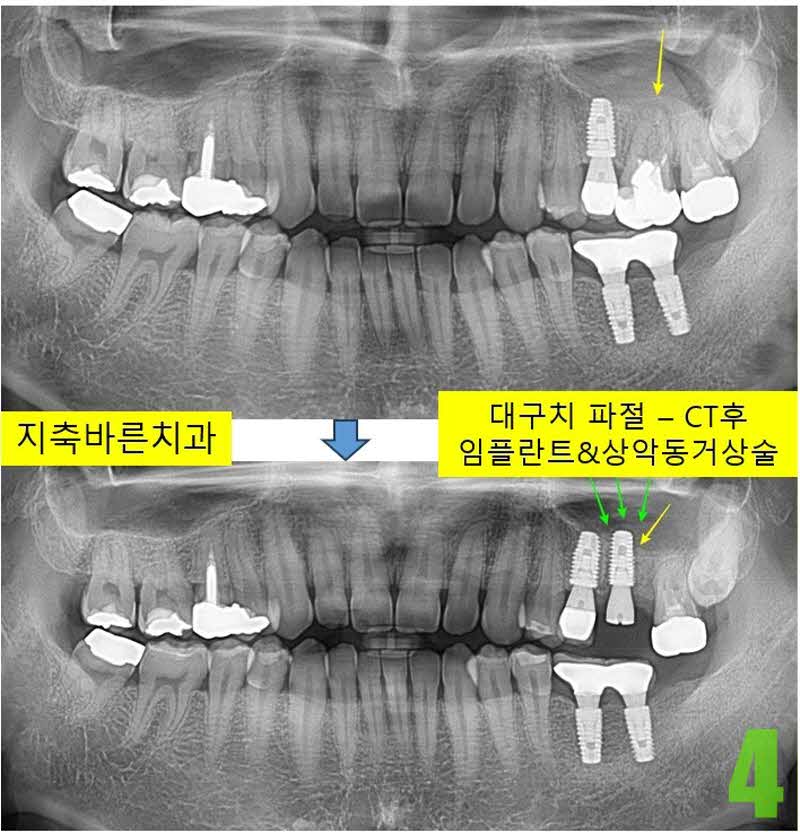 4. 임플 식립_s.jpg