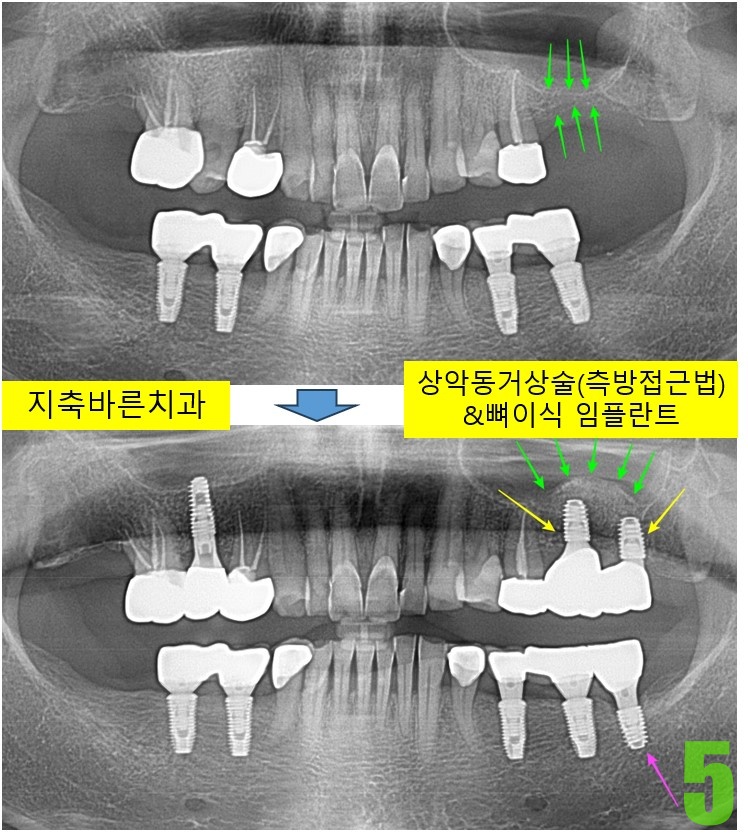 5. #26,27,37 보철.jpg