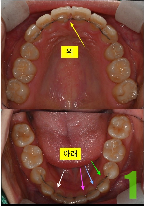 1. 초진 상하악.jpg