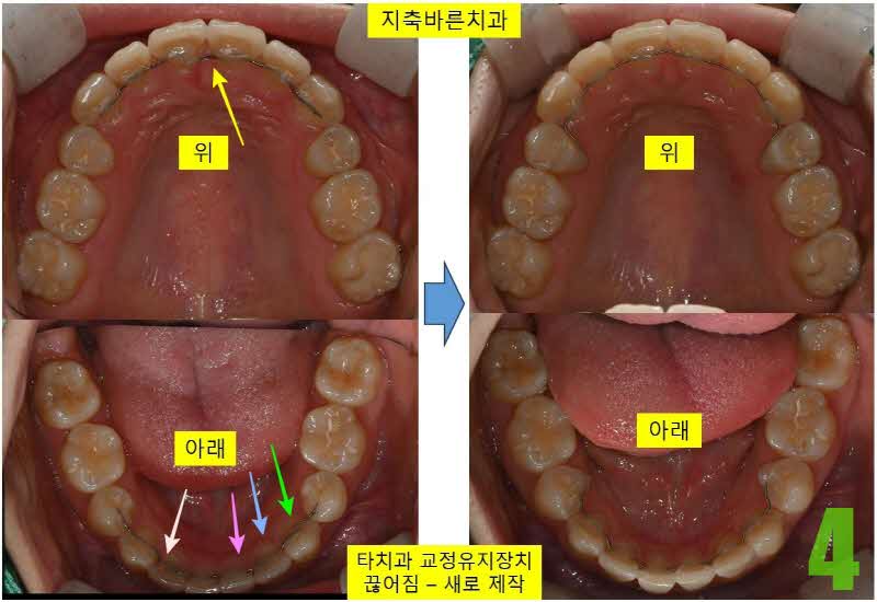 4. 타치과 유지장치 새로제작_s.jpg