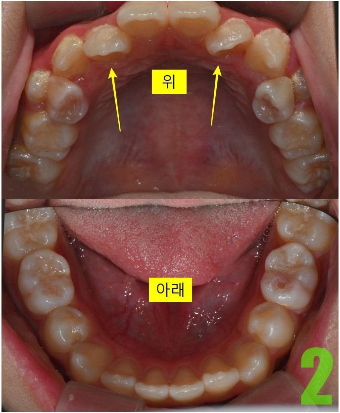 2. 초진 상하악.jpg