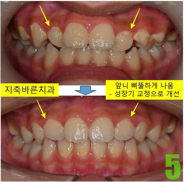 5. 치료전후.jpg