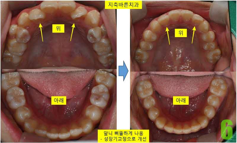 6. 상하악 앞니 개선_s.jpg