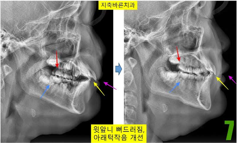 7. 치료전후 ceph_s.jpg