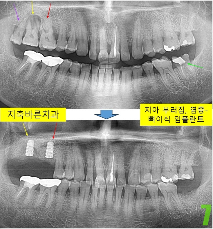 7. #16,17 임플란트 식립.jpg