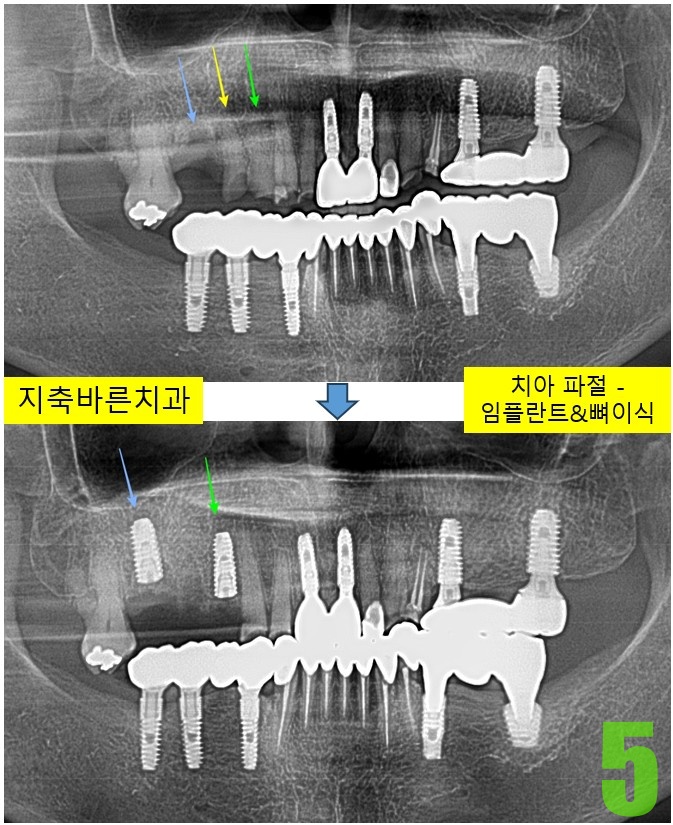 5. #14,16 임플 식립.jpg