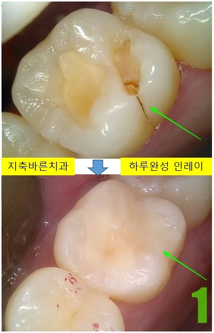 1. #26 치료전후.jpg