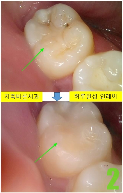 2. #47 치료전후.jpg