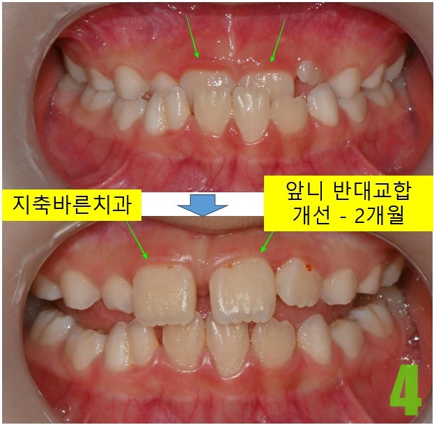 4. 치료 2개월 정면.jpg