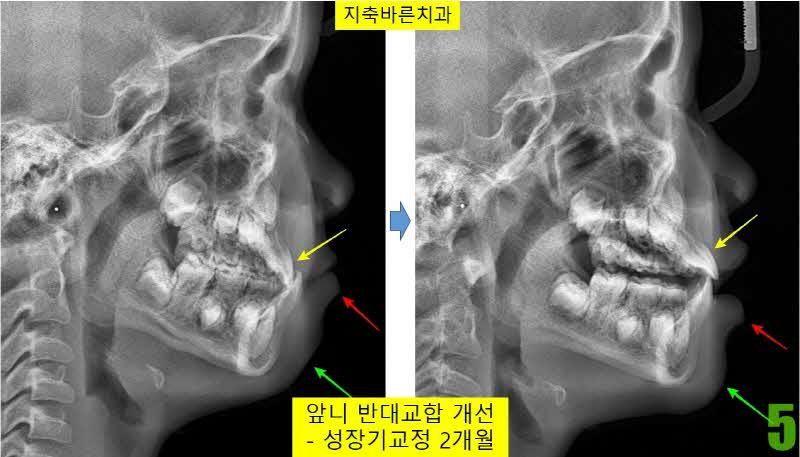 5. 치료전후 2개월 셉_s.jpg