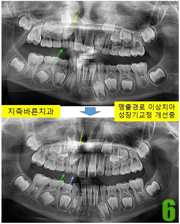 6. 치료전후 2개월 파노.jpg