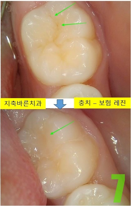 7. #36 레진 치료전후 - 복사본.jpg