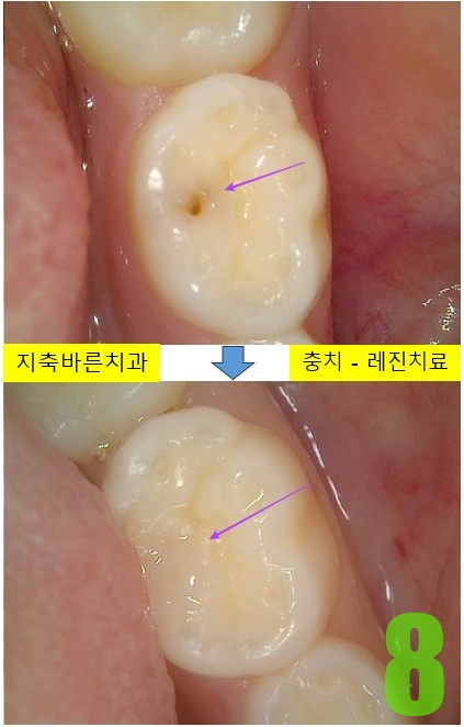 8. #75 레진 치료전후.jpg