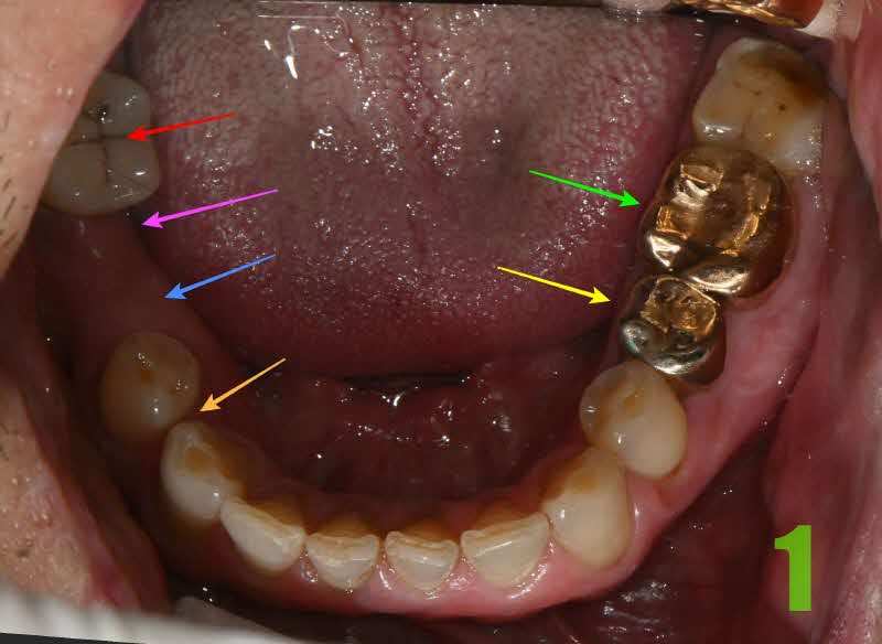 1. 초진 하악 교합면_s.jpg