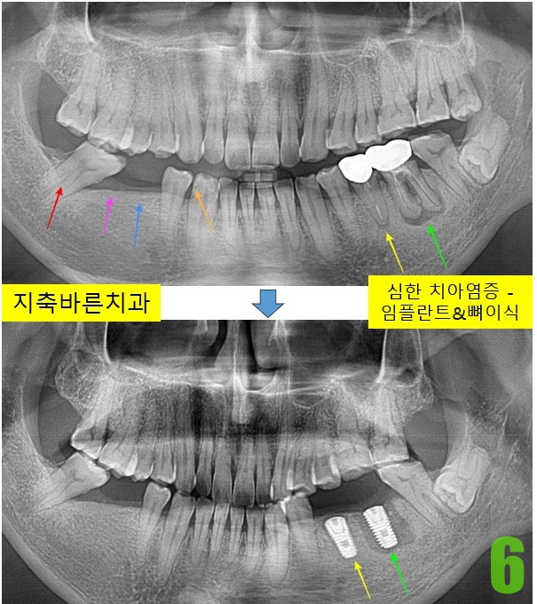 6. #35,36 임플 식립.jpg