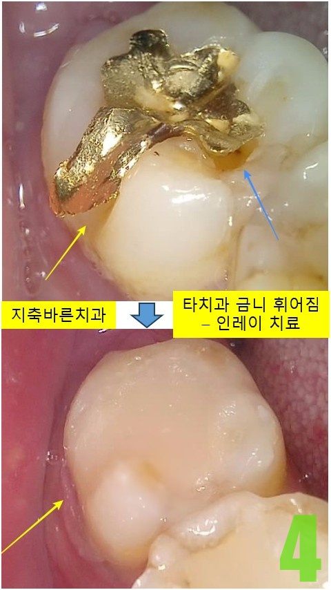 4. 치료전후.jpg