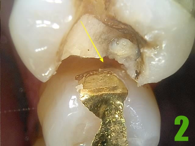 2. #25 충치.jpg
