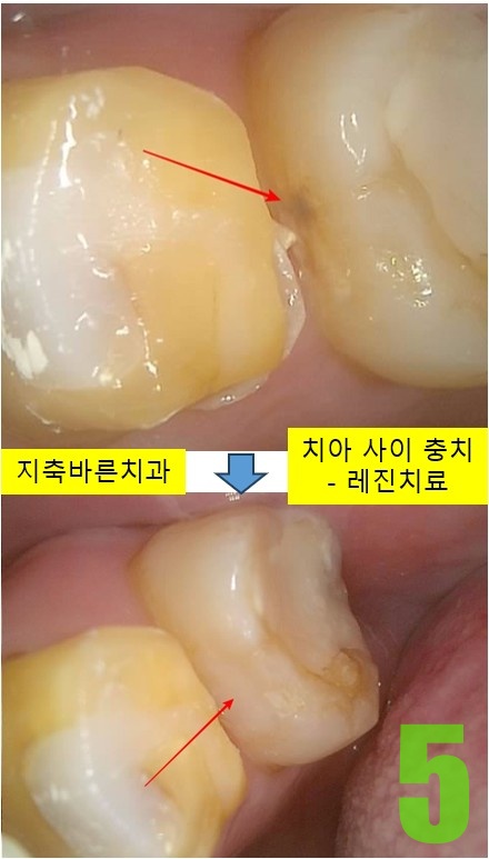 5. #27 레진치료.jpg