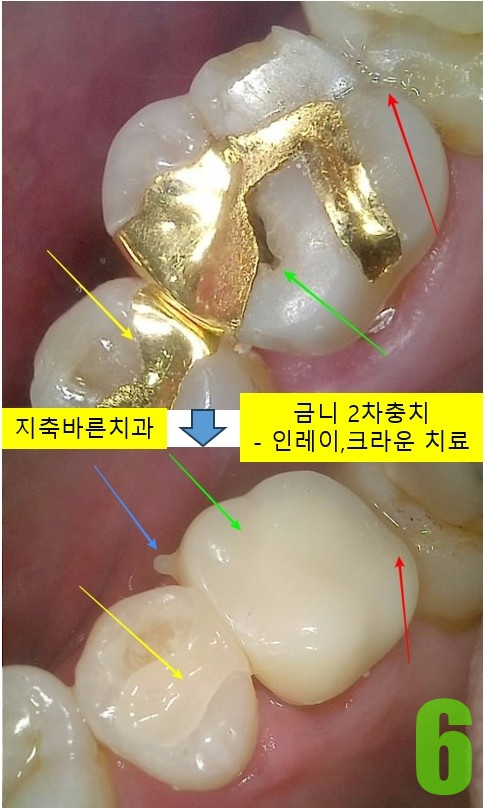 6. #25,26 인레이, 크라운.jpg