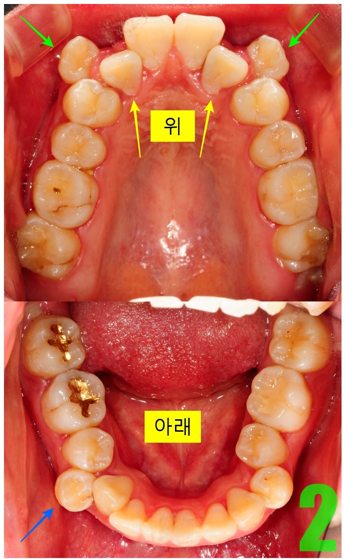 2. 초진 상하악.JPG