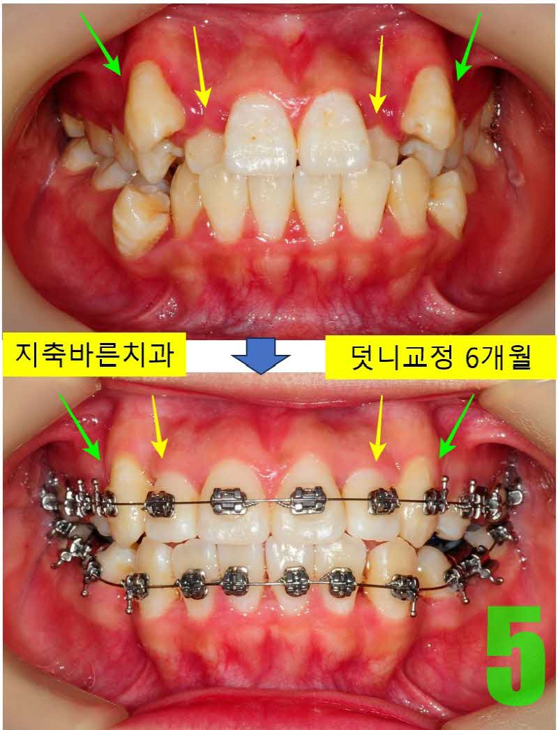 5. 6개월 정면_s.JPG