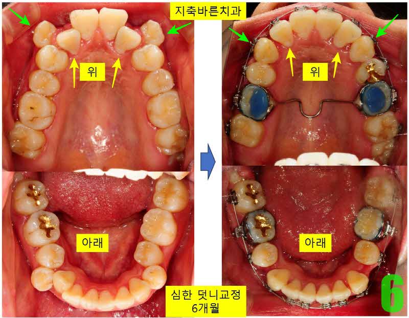 6. 6개월 상하악_s.JPG