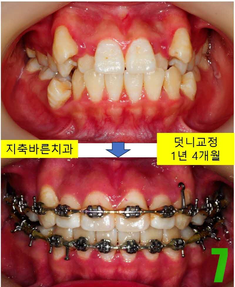 7. 1년 4개월 정면_s.JPG