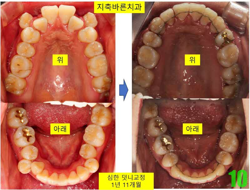 10. 디본딩 상하악_s.JPG