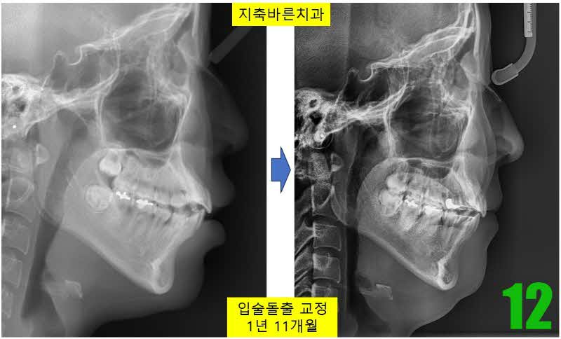 12. 디본딩 ceph_s.jpg