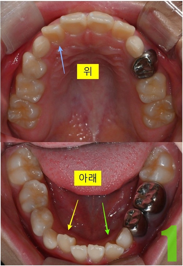 1. 초진 상하악.jpg