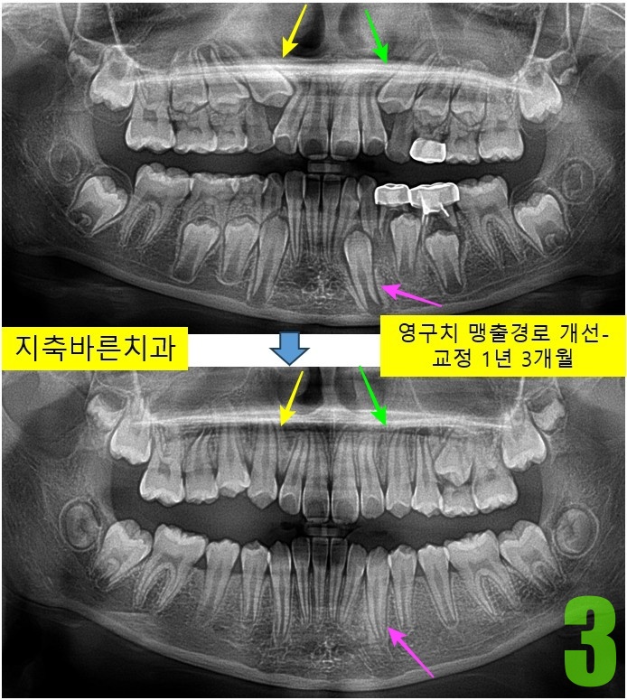 3. 1년 3개월 파노.jpg