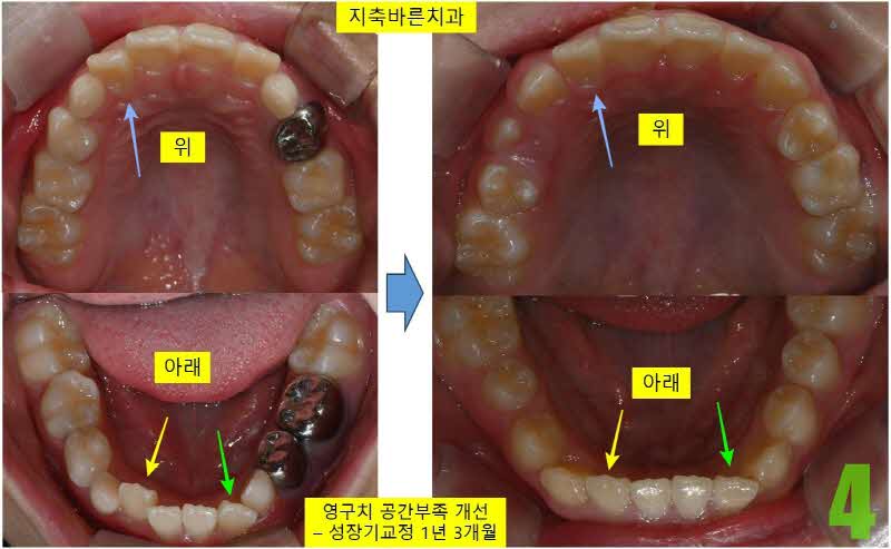 4. 1년 3개월 교합면_s.jpg