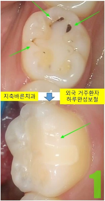 1. #36 치료전후.jpg