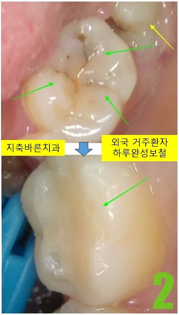 2. #37 치료전후.jpg