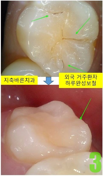 3. #17 치료전후.jpg